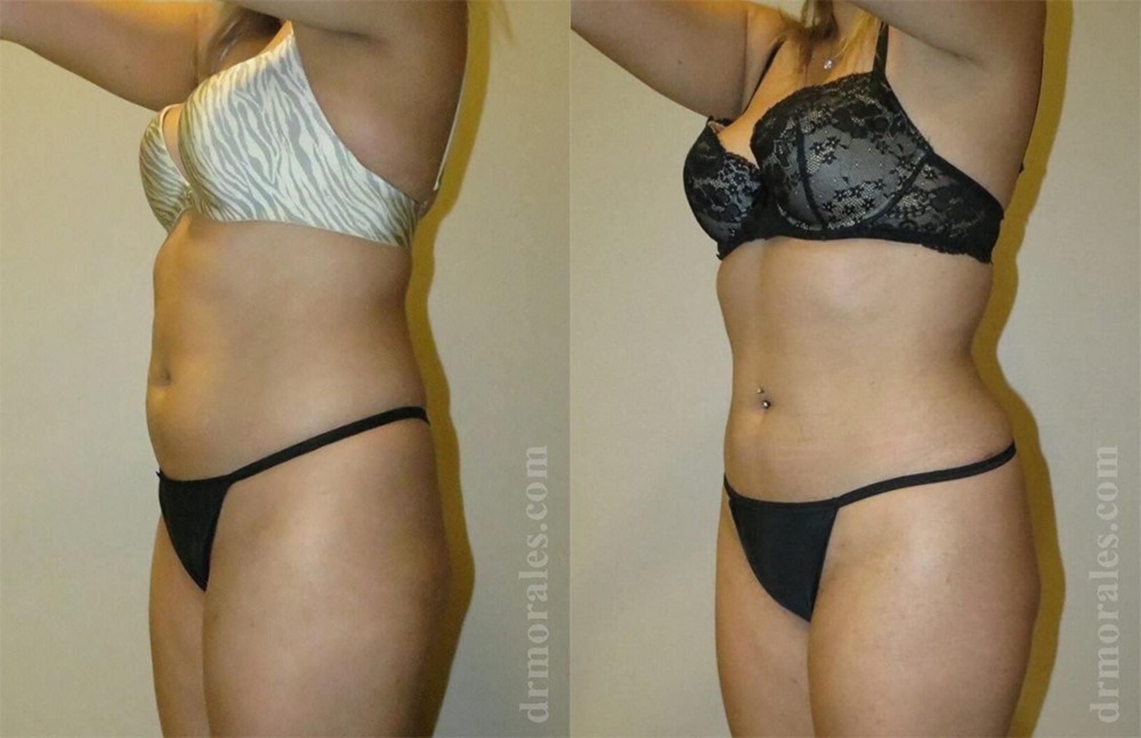 Before & After Liposuction Case 449 View 1 View in Houston, TX