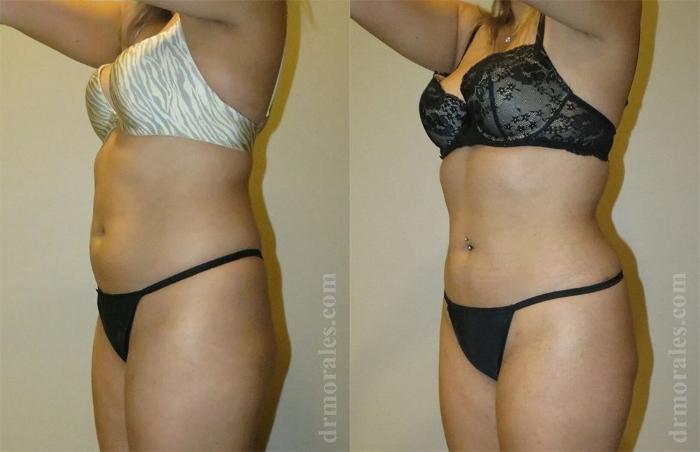 Before & After Liposuction Case 449 View 1 View in Houston, TX