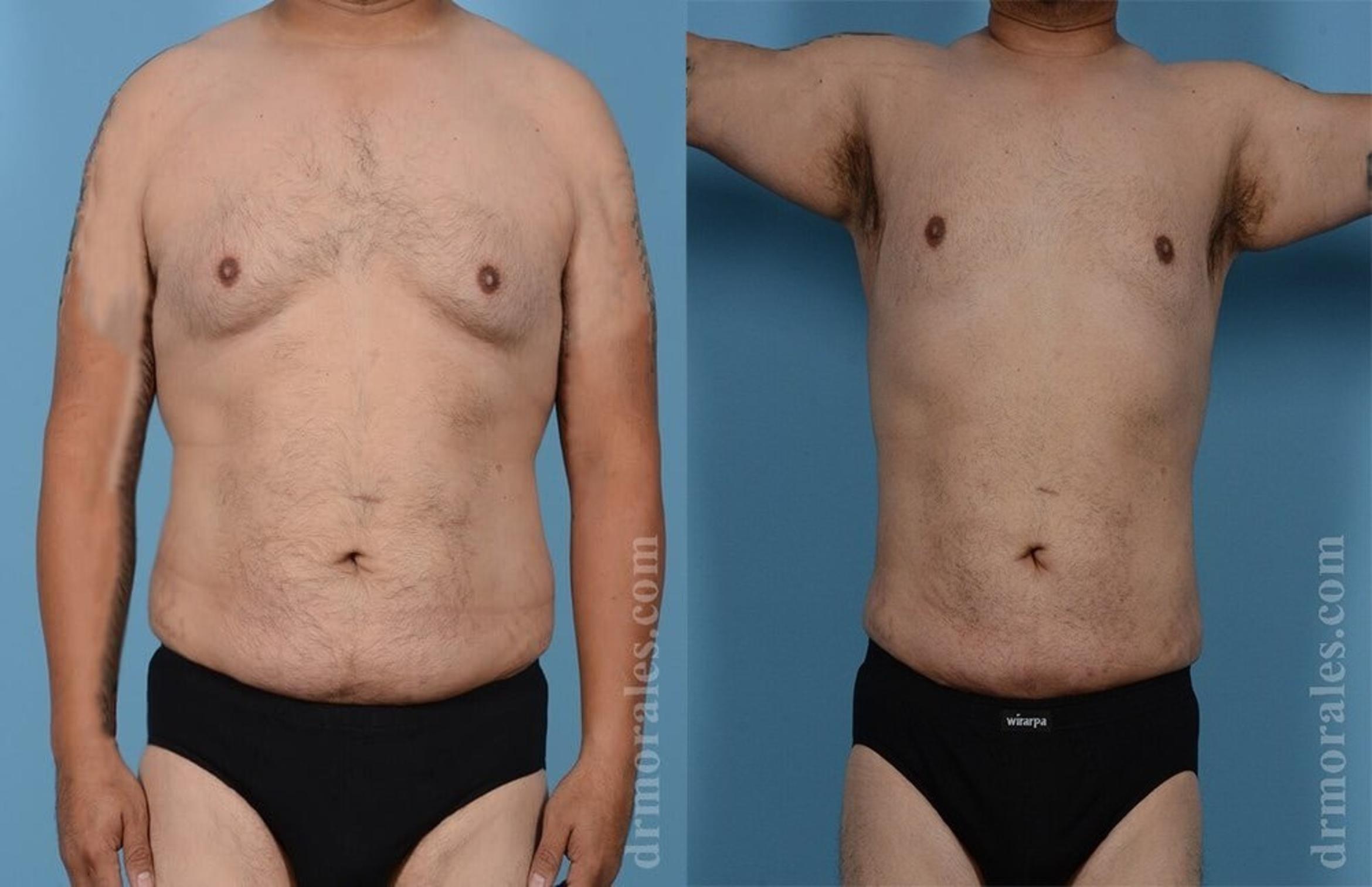Before & After Liposuction Case 451 View 1 View in Houston, TX