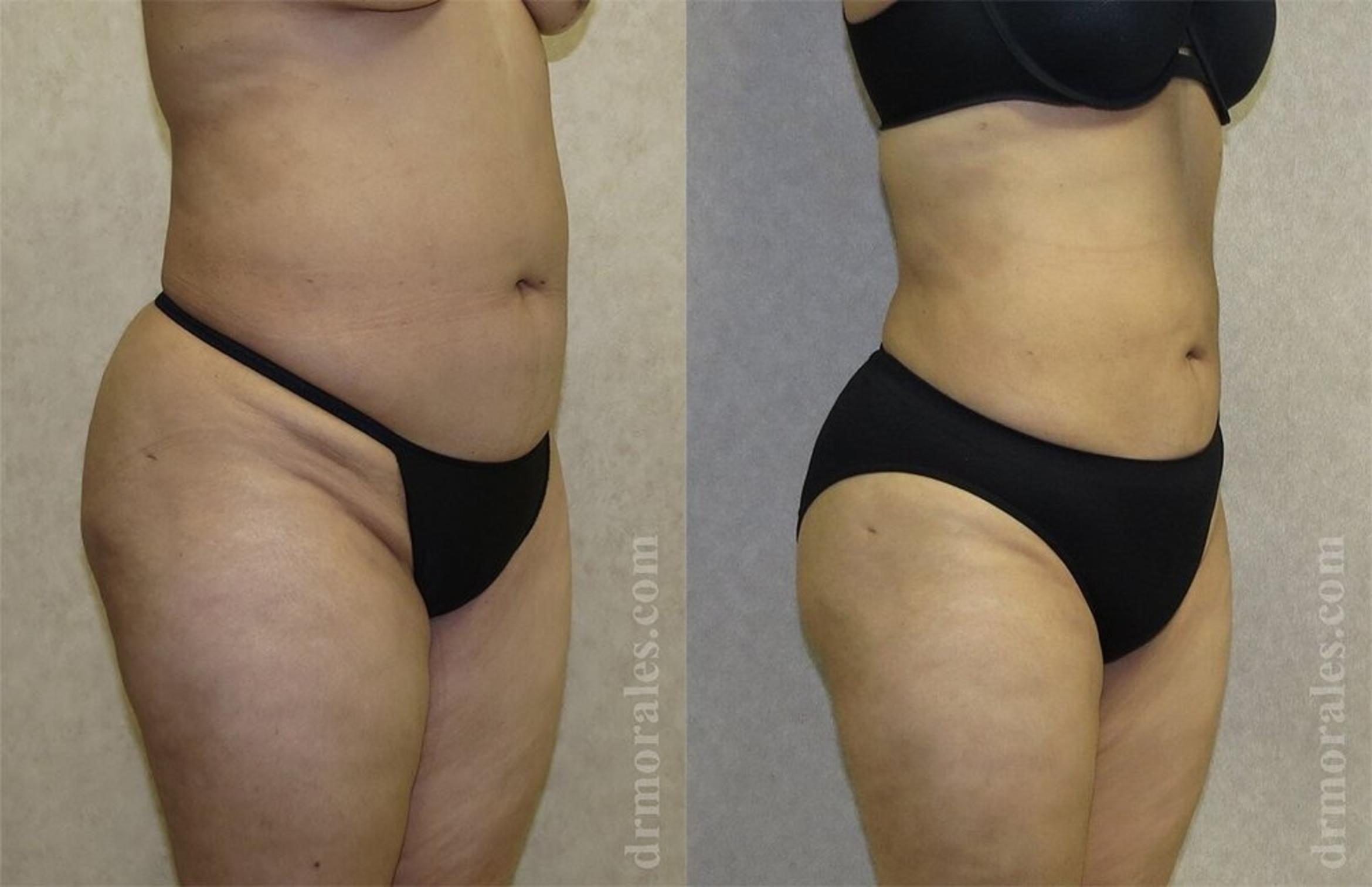 Before & After Liposuction Case 452 View 1 View in Houston, TX