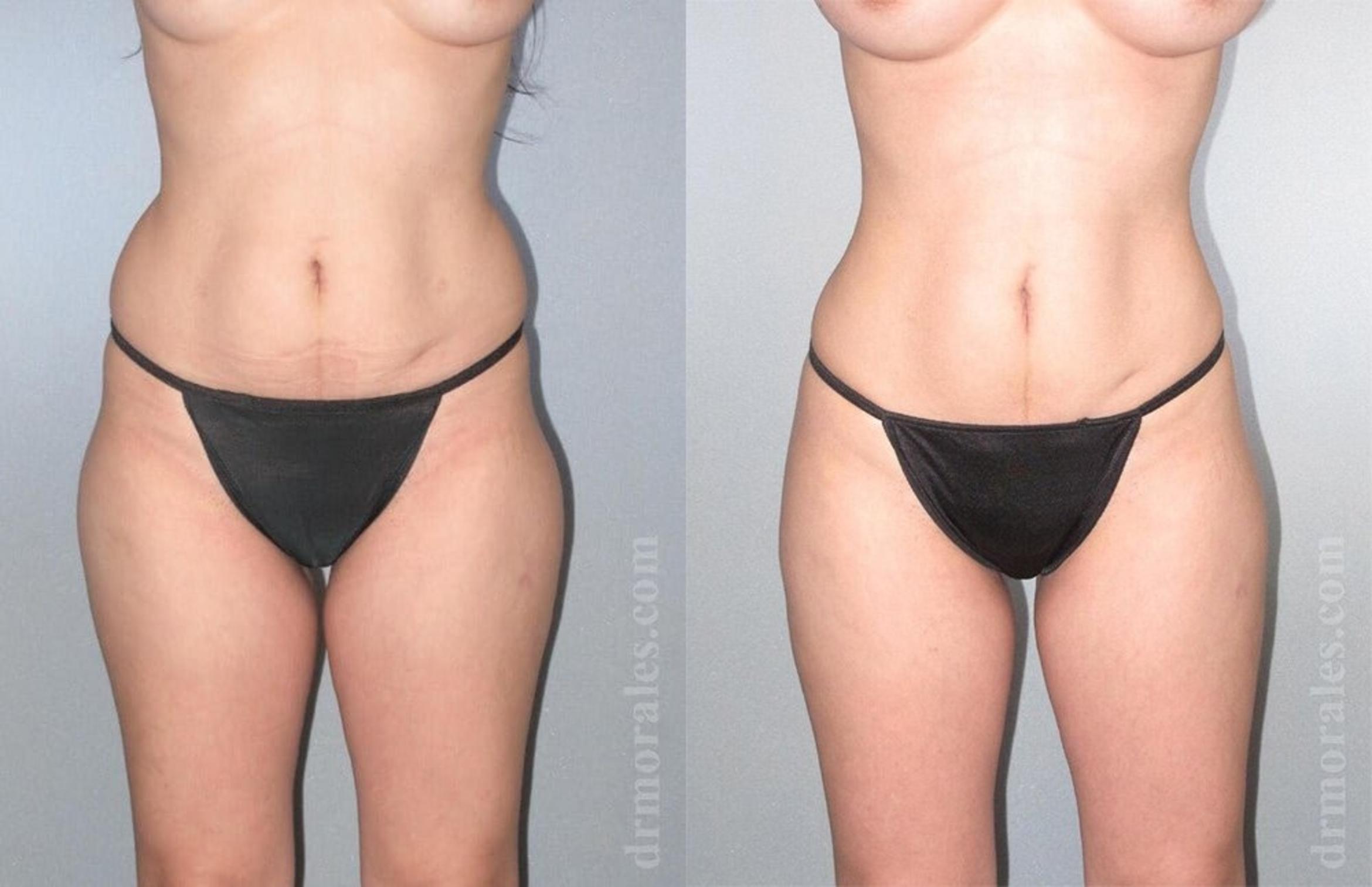 Before & After Liposuction Case 453 View 1 View in Houston, TX