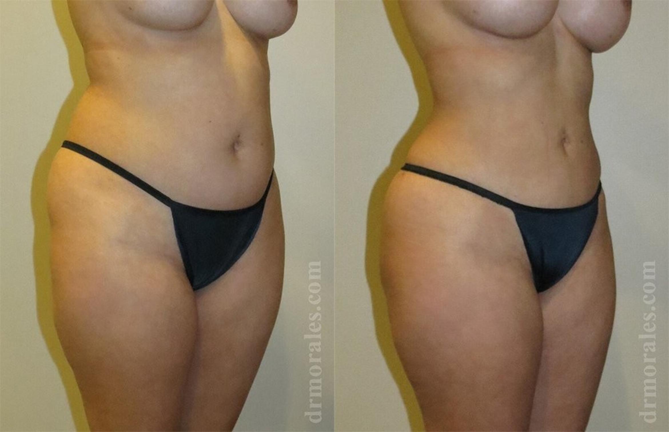 Before & After Liposuction Case 456 View 1 View in Houston, TX