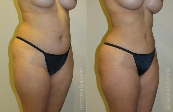 Before & After Liposuction Case 456 View 1 View in Houston, TX