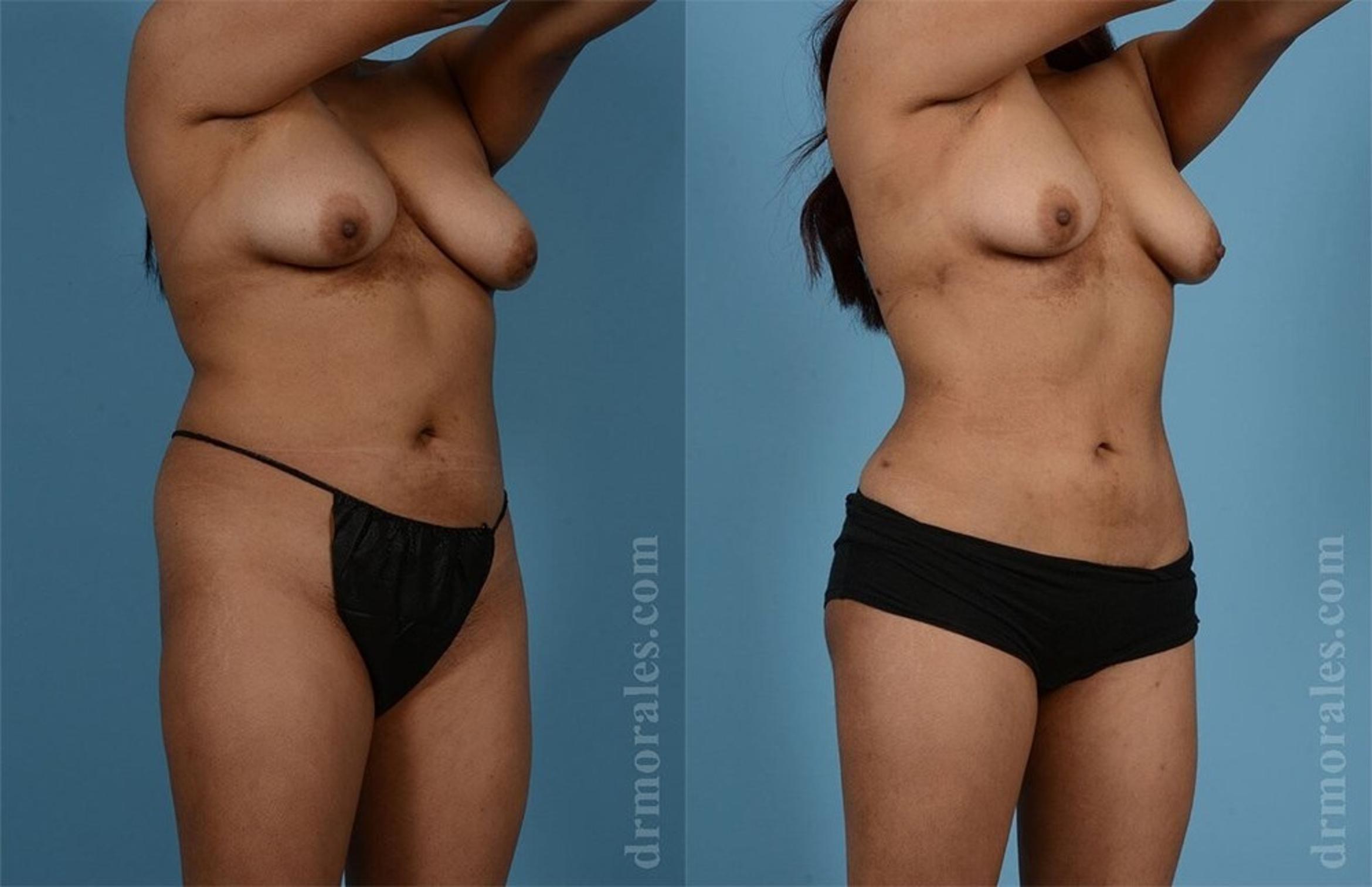 Before & After Liposuction Case 458 View 1 View in Houston, TX