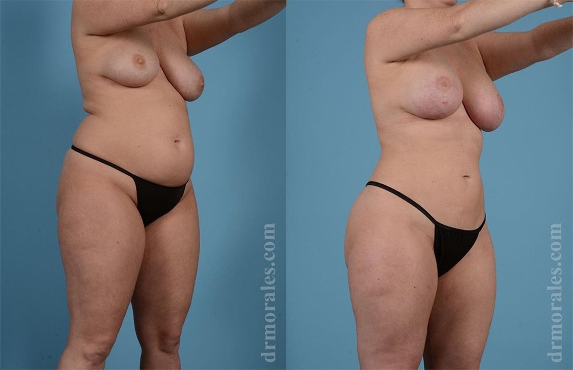 Before & After Liposuction Case 460 View 1 View in Houston, TX