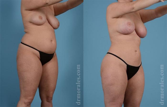 Before & After Liposuction Case 460 View 1 View in Houston, TX