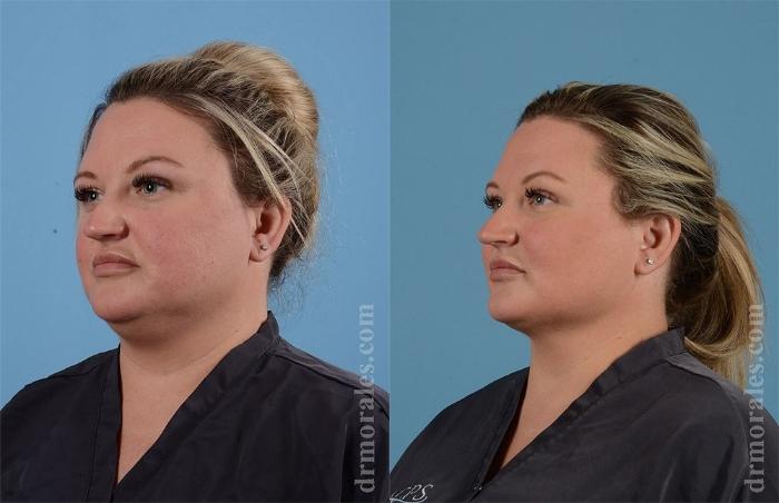 Before & After Liposuction Case 461 View 1 View in Houston, TX