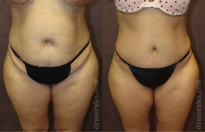 Before & After Liposuction Case 508 View 1 View in Houston, TX