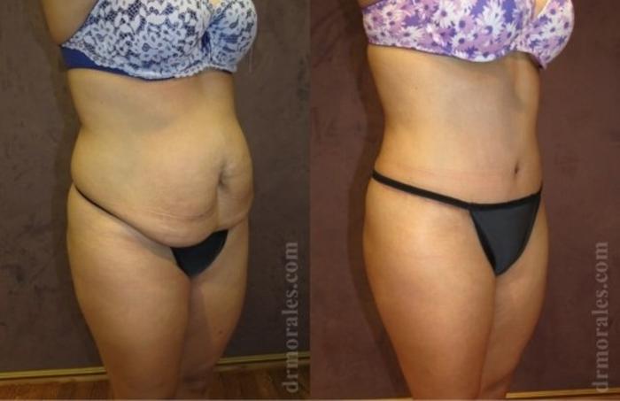 Before & After Liposuction Case 512 View 1 View in Houston, TX
