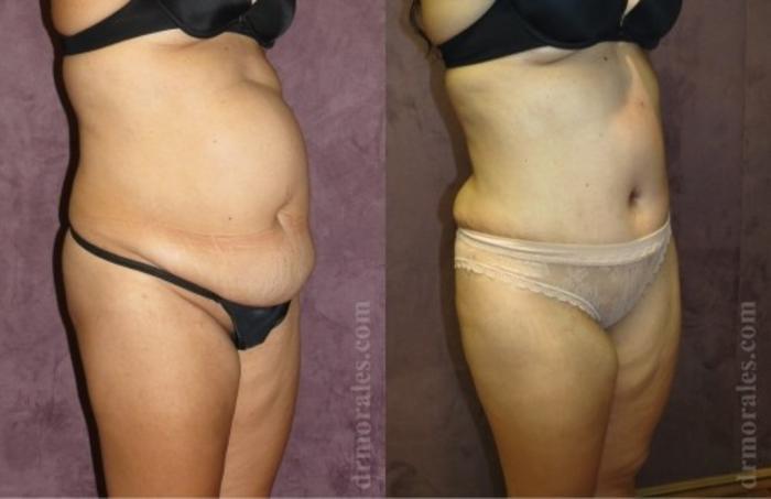 Before & After Liposuction Case 513 View 1 View in Houston, TX