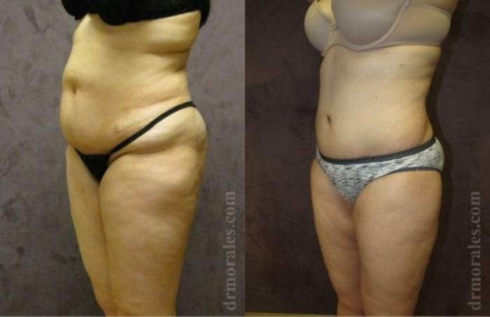 Before & After Liposuction Case 535 View 1 View in Houston, TX