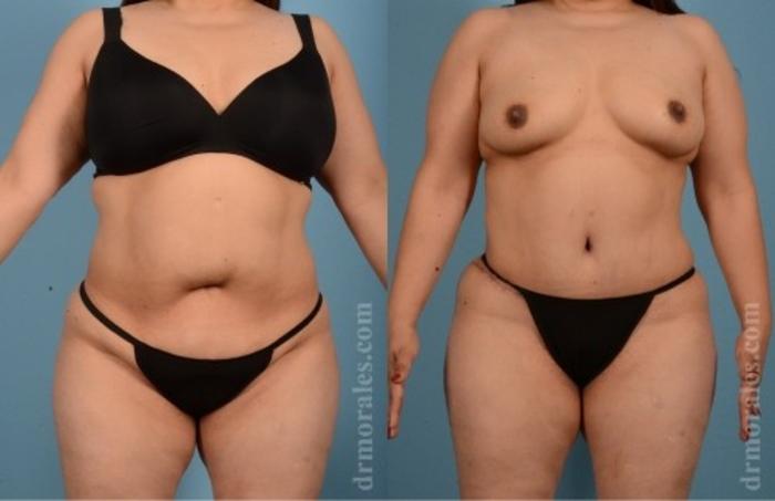 Before & After Liposuction Case 554 View 1 View in Houston, TX