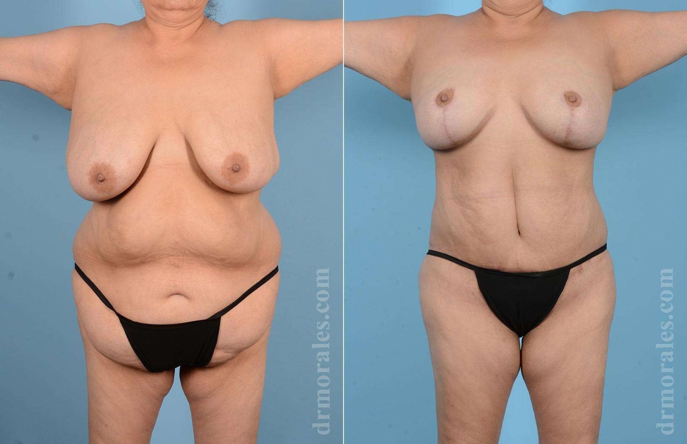 Before & After Mommy Makeover Case 12 View 1 View in Houston, TX