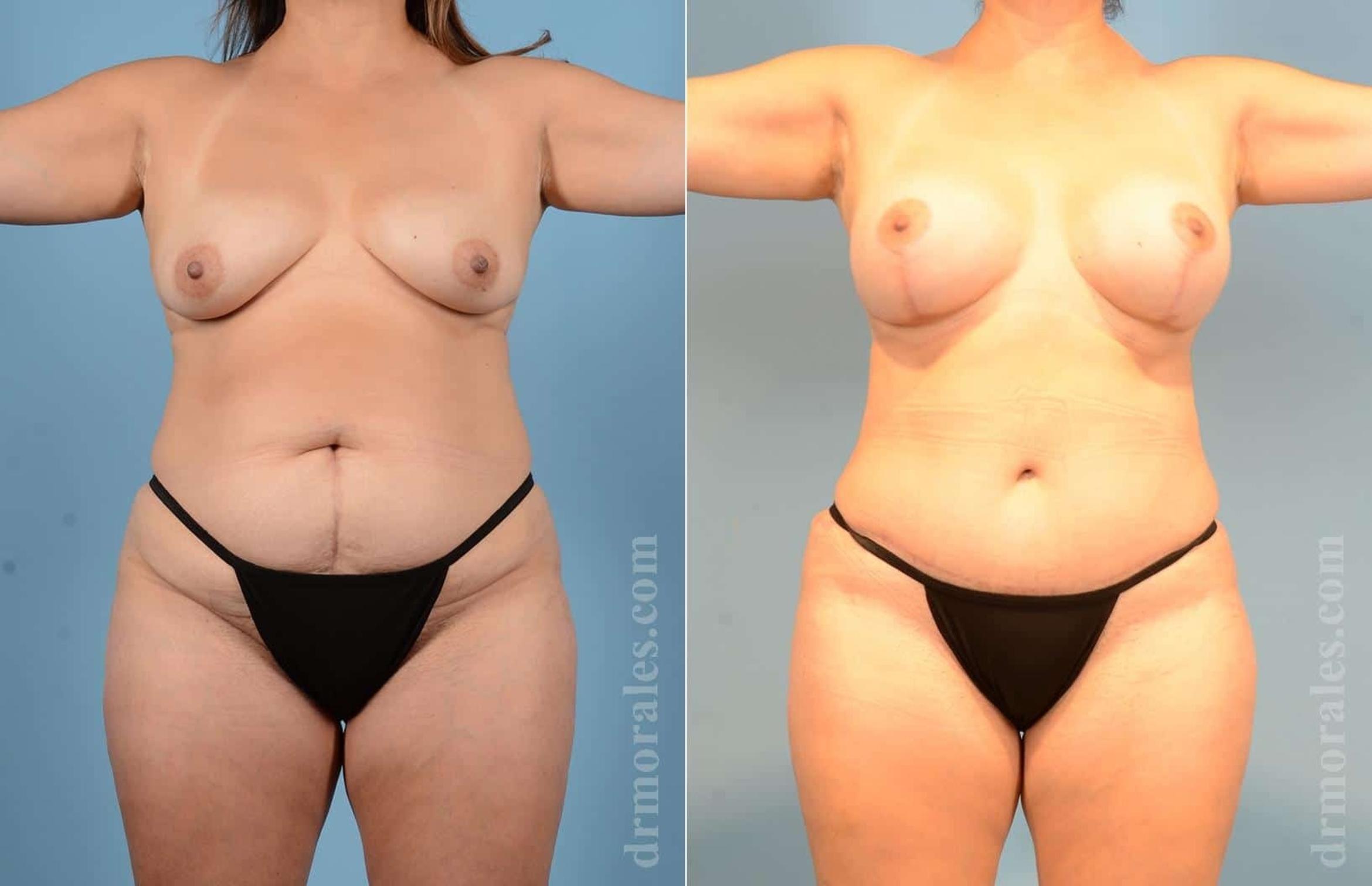 Before & After Mommy Makeover Case 17 View 1 View in Houston, TX