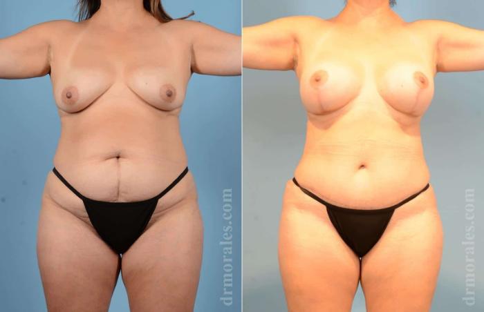 Before & After Mommy Makeover Case 17 View 1 View in Houston, TX