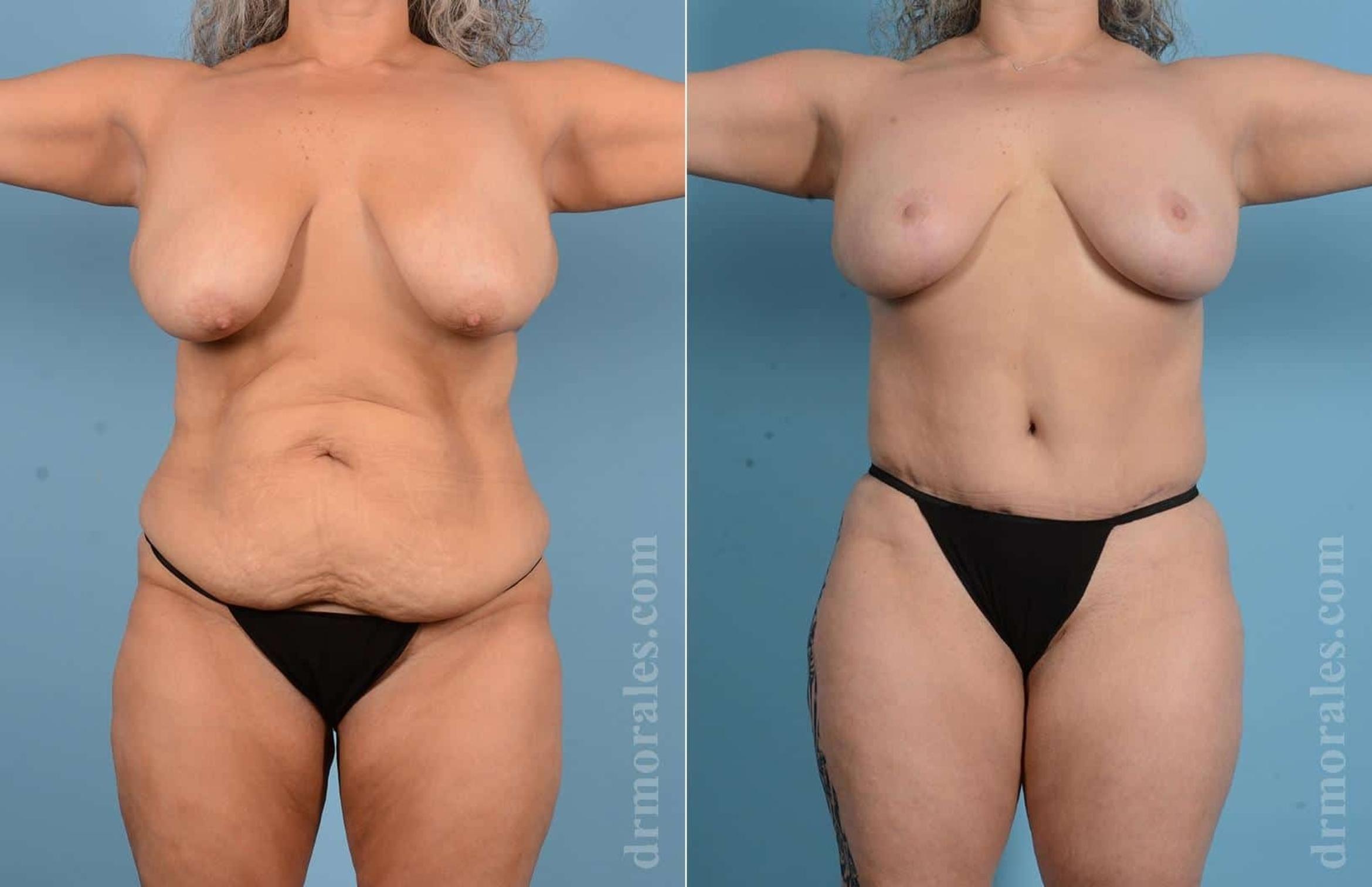 Before & After Mommy Makeover Case 20 View 1 View in Houston, TX