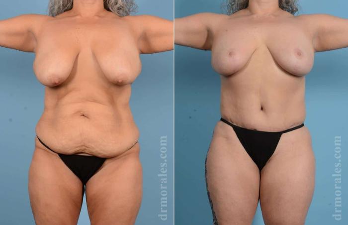 Before & After Mommy Makeover Case 20 View 1 View in Houston, TX