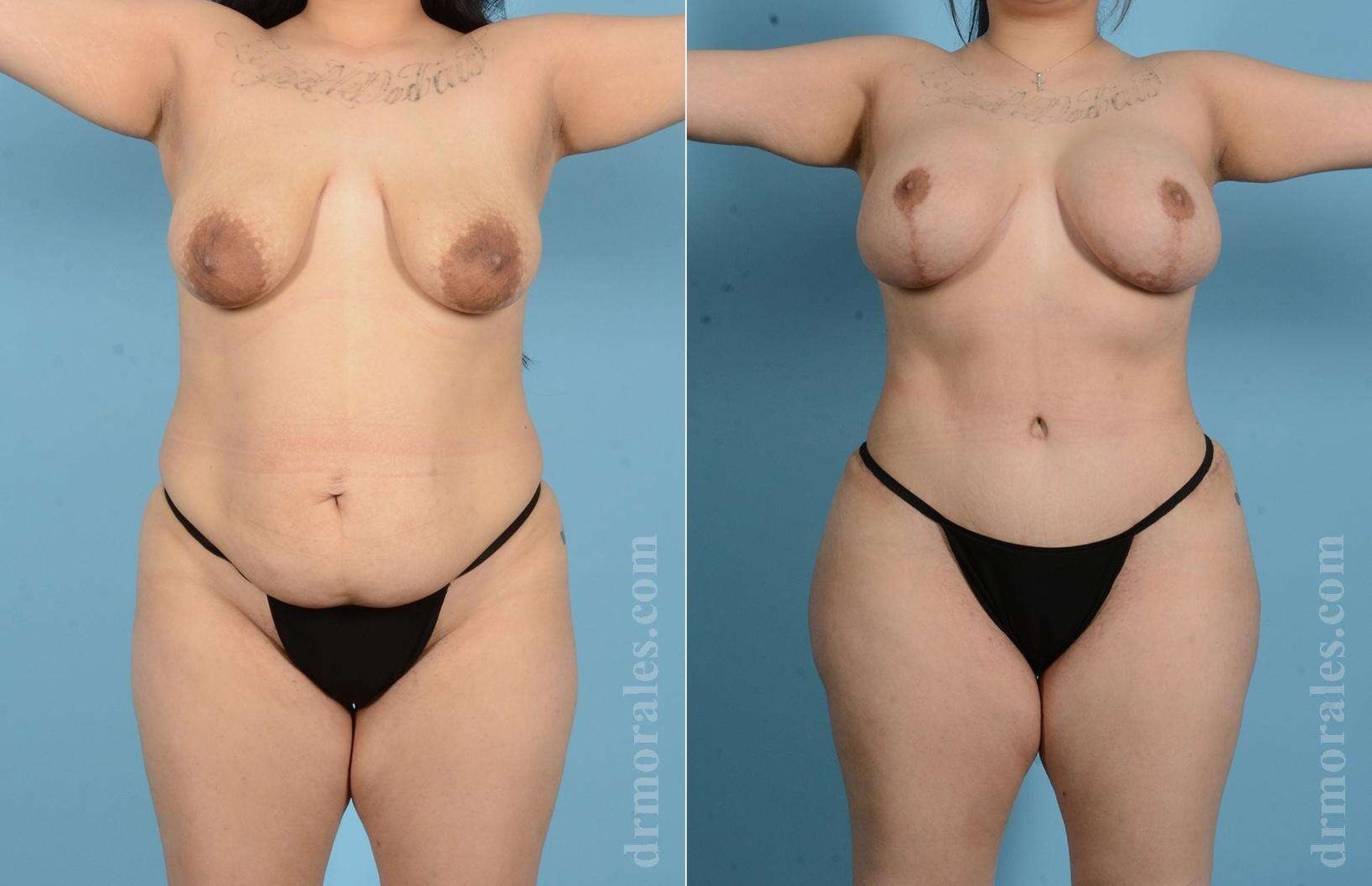 Before & After Mommy Makeover Case 22 View 1 View in Houston, TX