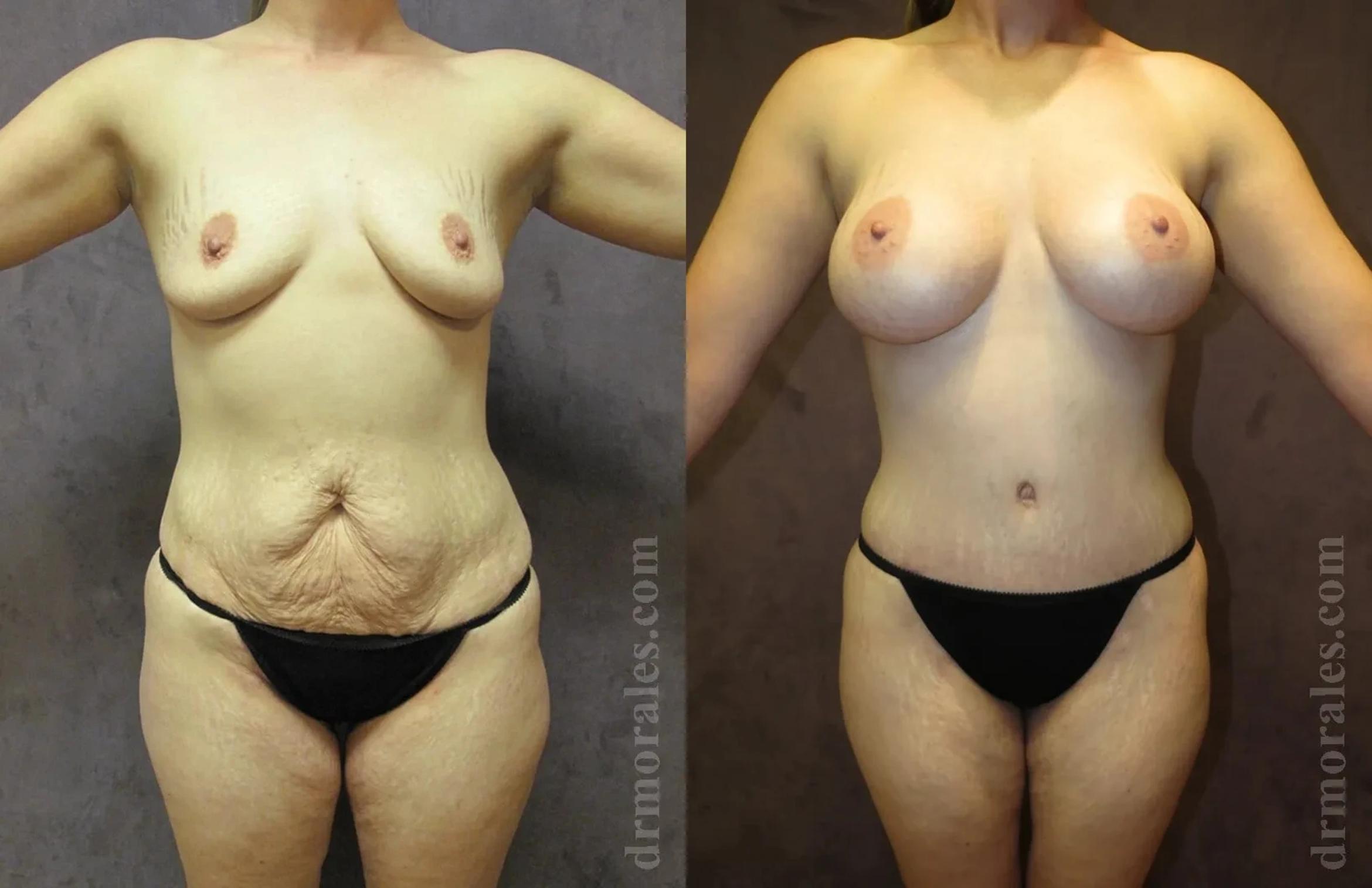 Before & After Mommy Makeover Case 231 View 1 View in Houston, TX