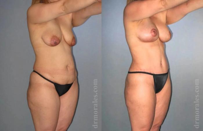 Before & After Mommy Makeover Case 232 View 1 View in Houston, TX