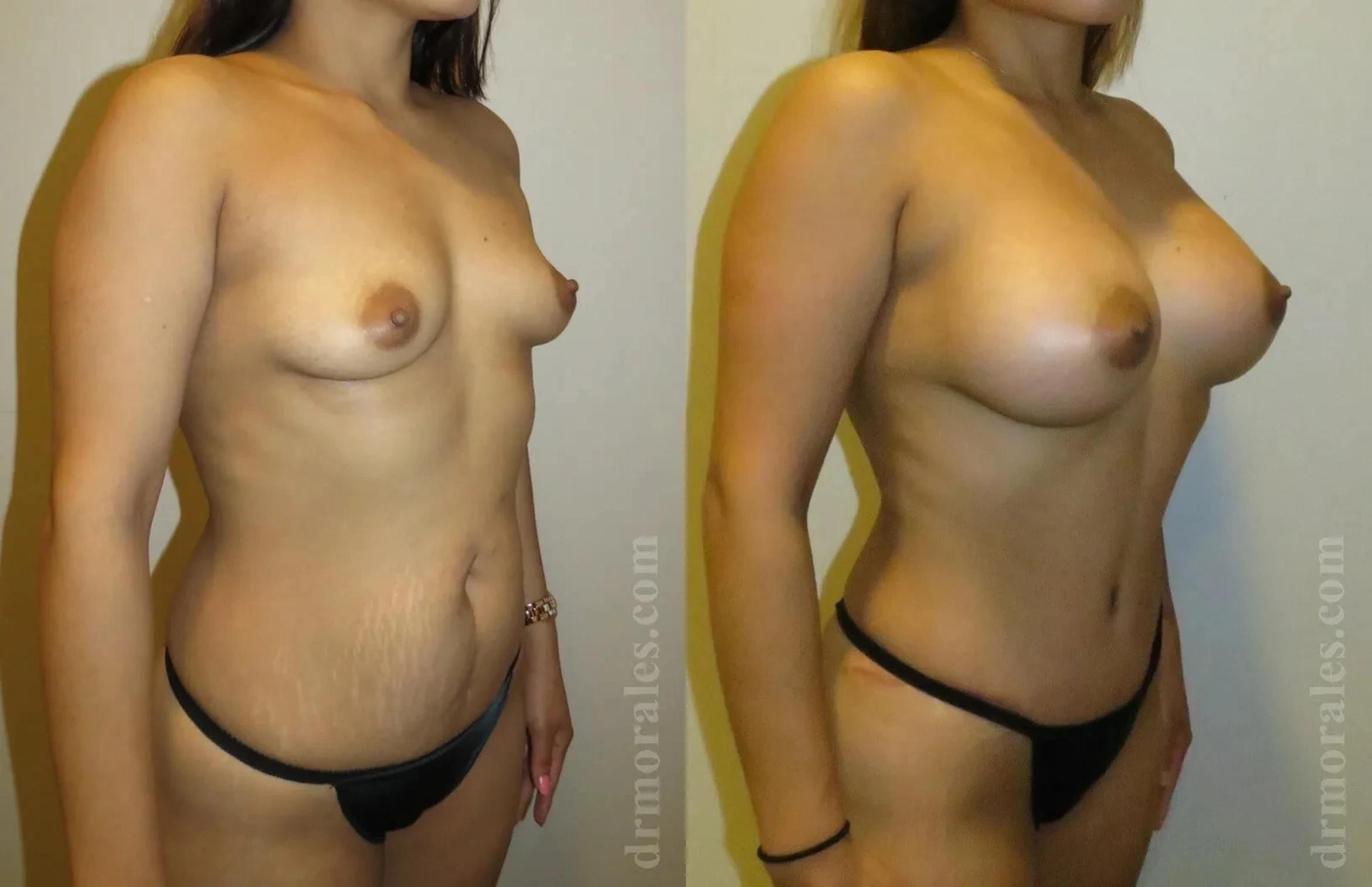 Before & After Mommy Makeover Case 234 View 1 View in Houston, TX