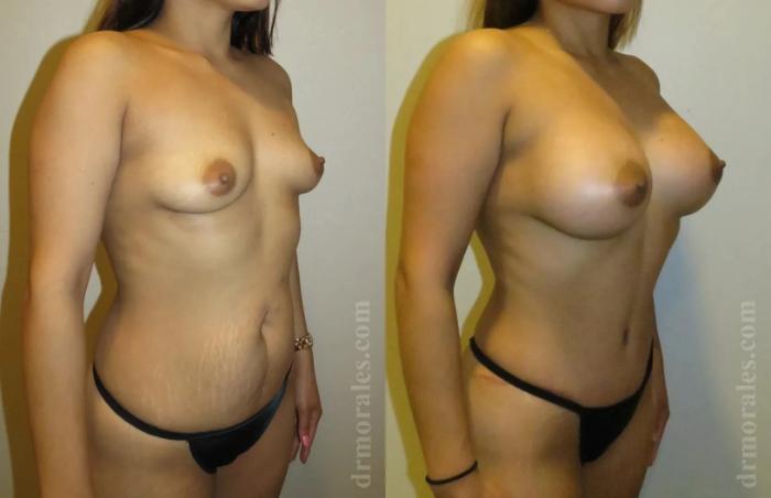 Before & After Mommy Makeover Case 234 View 1 View in Houston, TX