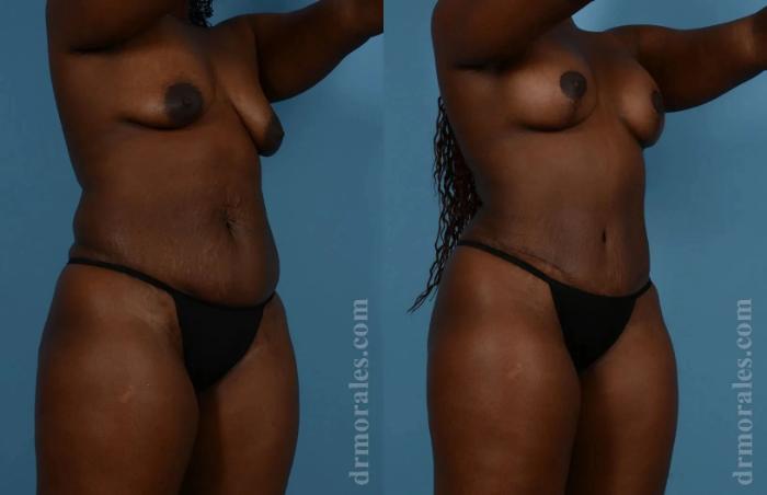 Before & After Mommy Makeover Case 235 View 1 View in Houston, TX