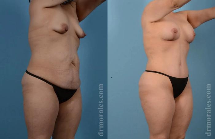 Before & After Mommy Makeover Case 237 View 1 View in Houston, TX