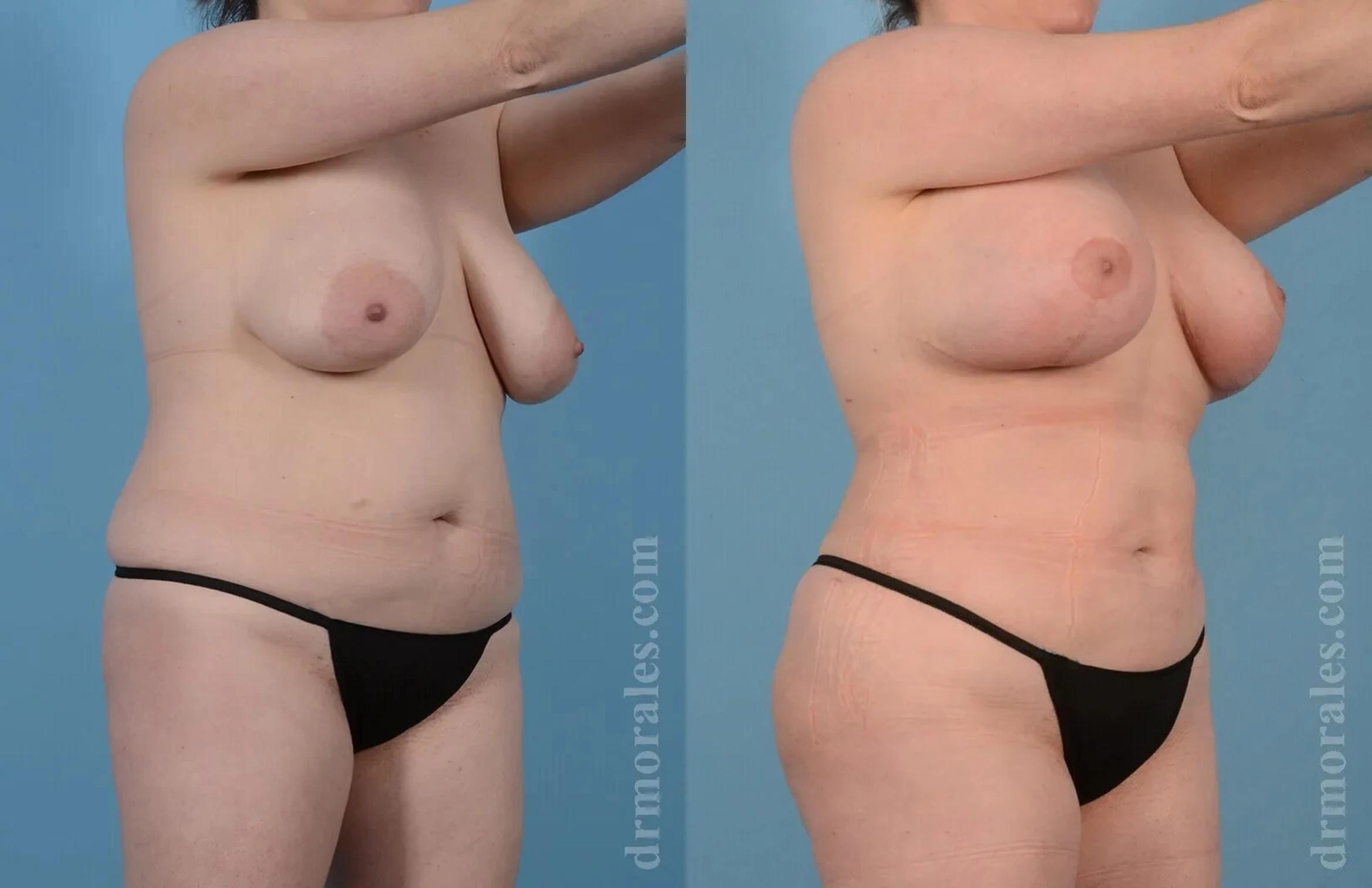 Before & After Mommy Makeover Case 238 View 1 View in Houston, TX