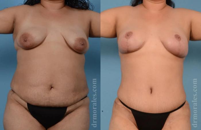 Before & After Mommy Makeover Case 239 View 1 View in Houston, TX