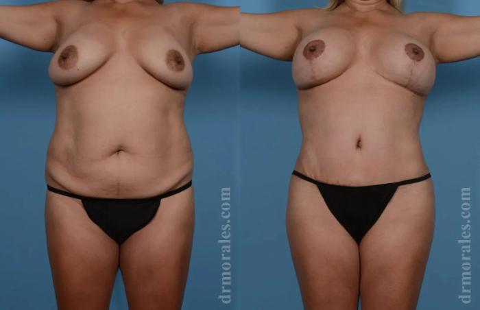 Before & After Mommy Makeover Case 240 View 1 View in Houston, TX