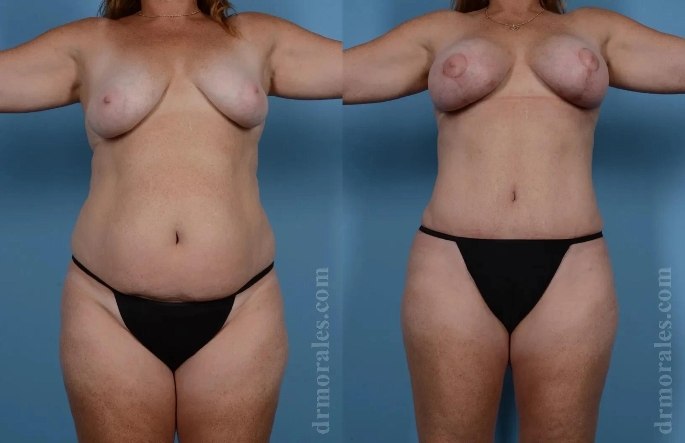 Before & After Mommy Makeover Case 241 View 1 View in Houston, TX