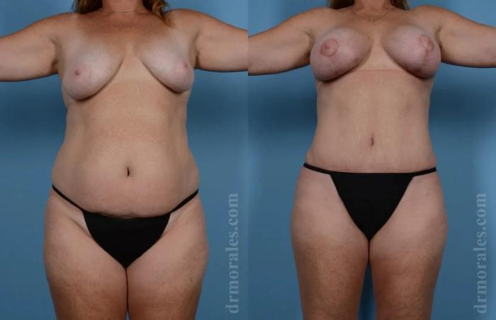 Before & After Mommy Makeover Case 241 View 1 View in Houston, TX