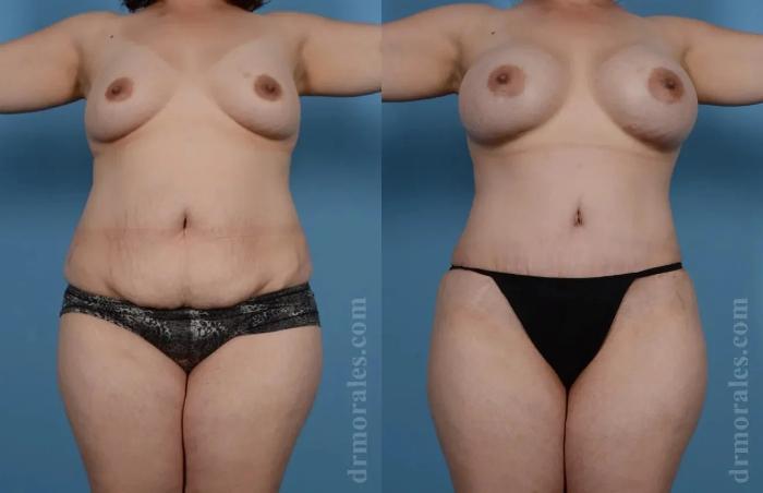 Before & After Mommy Makeover Case 242 View 1 View in Houston, TX