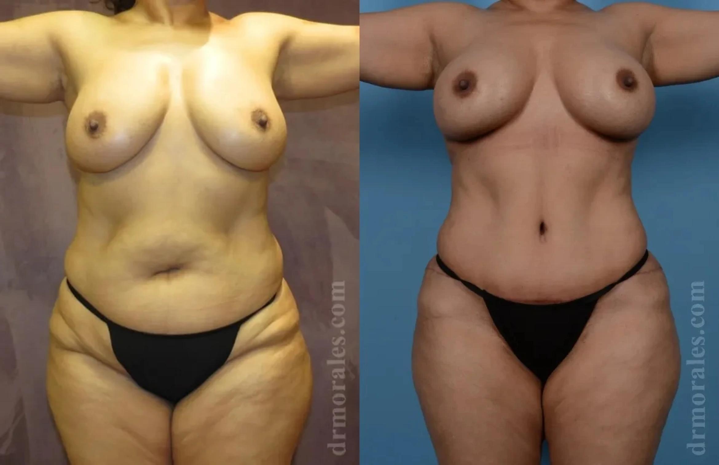 Before & After Mommy Makeover Case 243 View 1 View in Houston, TX