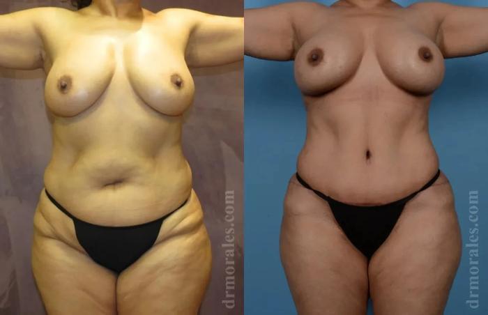 Before & After Mommy Makeover Case 243 View 1 View in Houston, TX