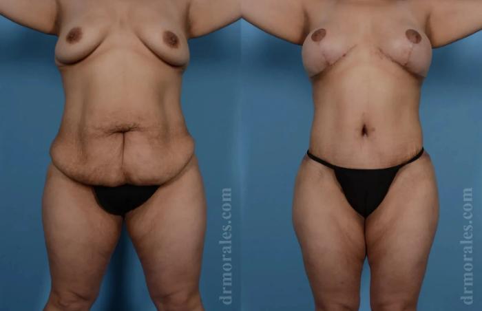 Before & After Mommy Makeover Case 244 View 1 View in Houston, TX