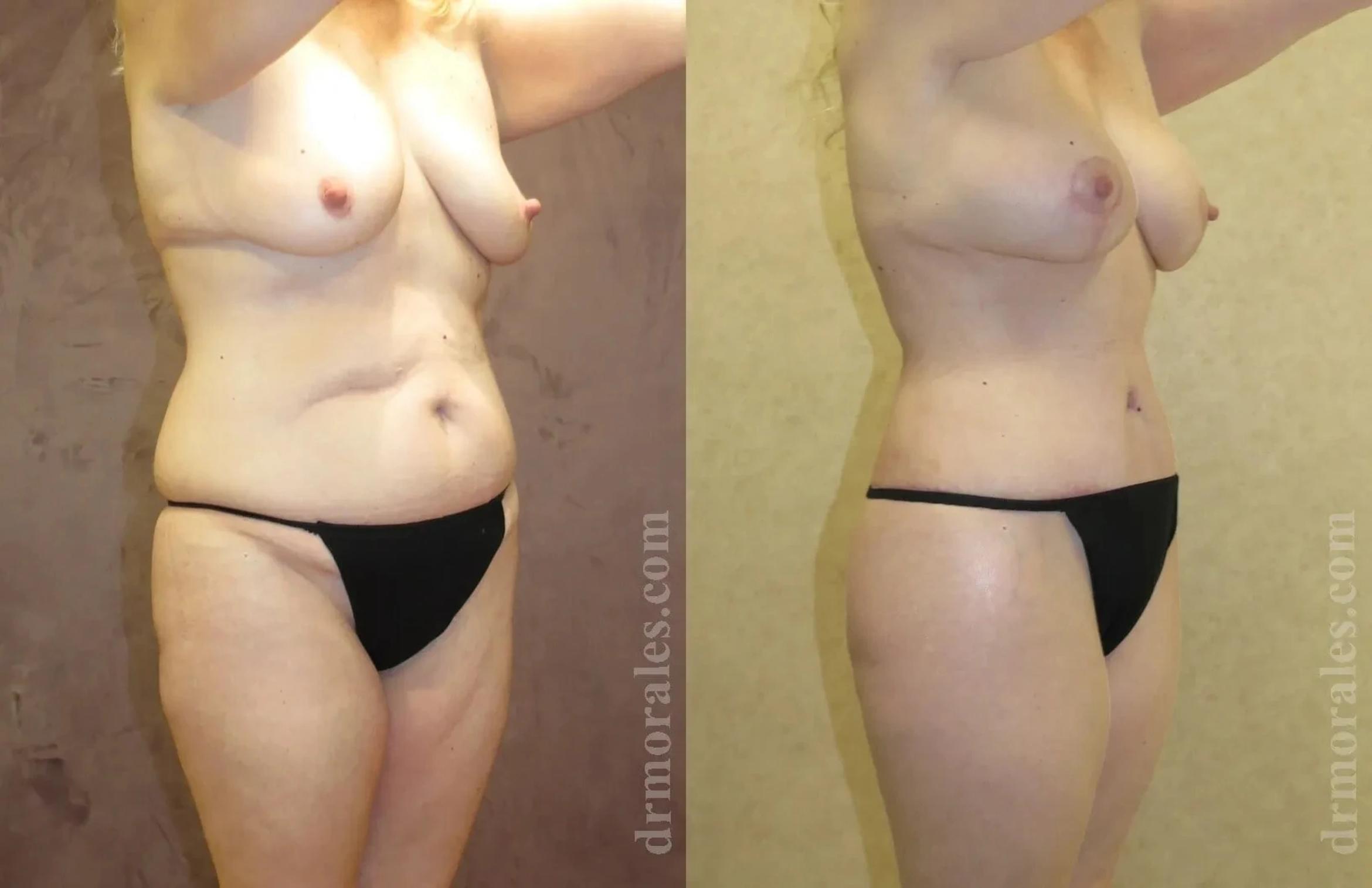 Before & After Mommy Makeover Case 248 View 1 View in Houston, TX