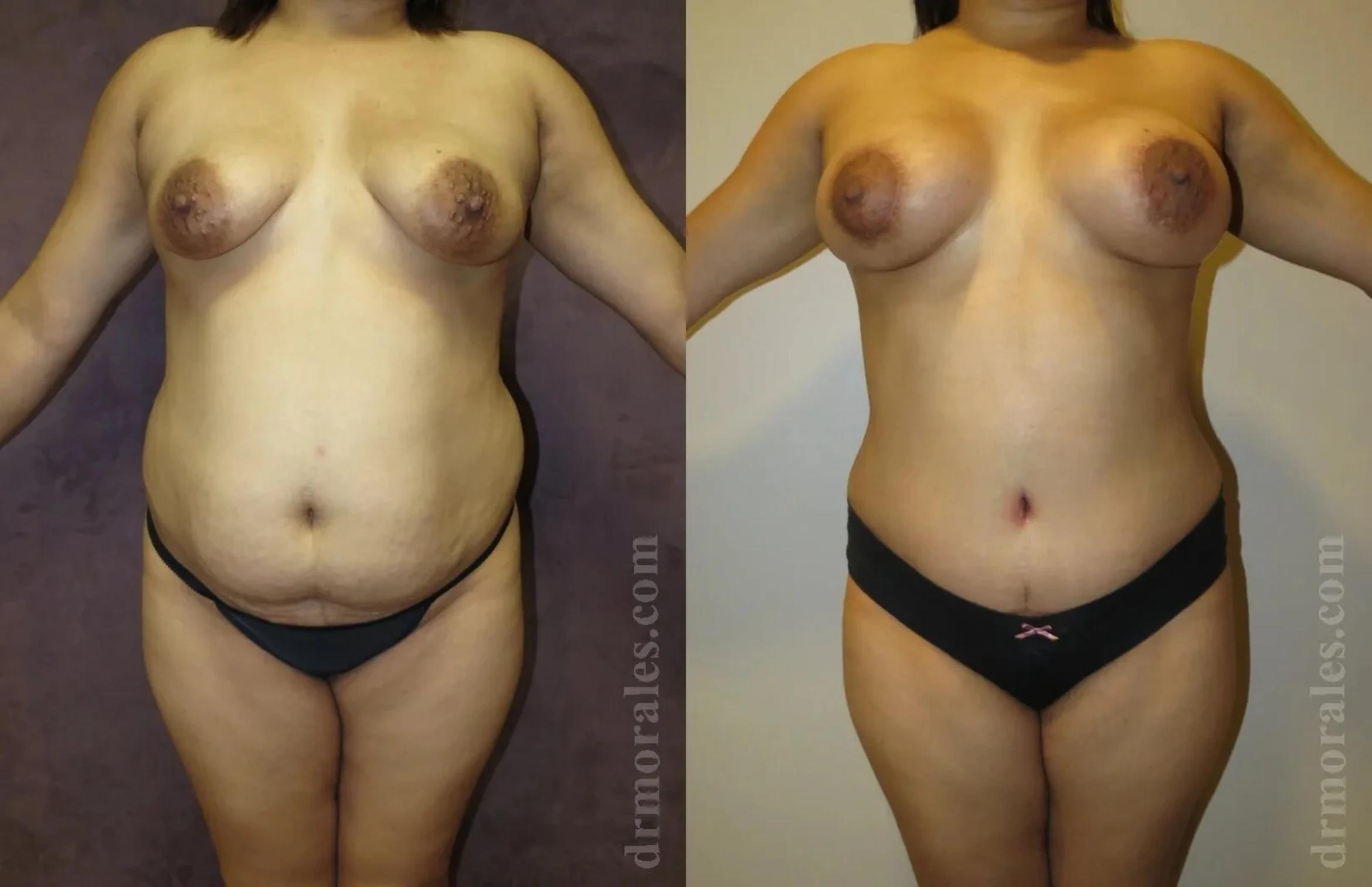 Before & After Mommy Makeover Case 249 View 1 View in Houston, TX