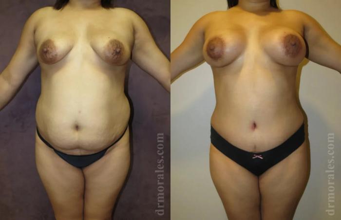 Before & After Mommy Makeover Case 249 View 1 View in Houston, TX