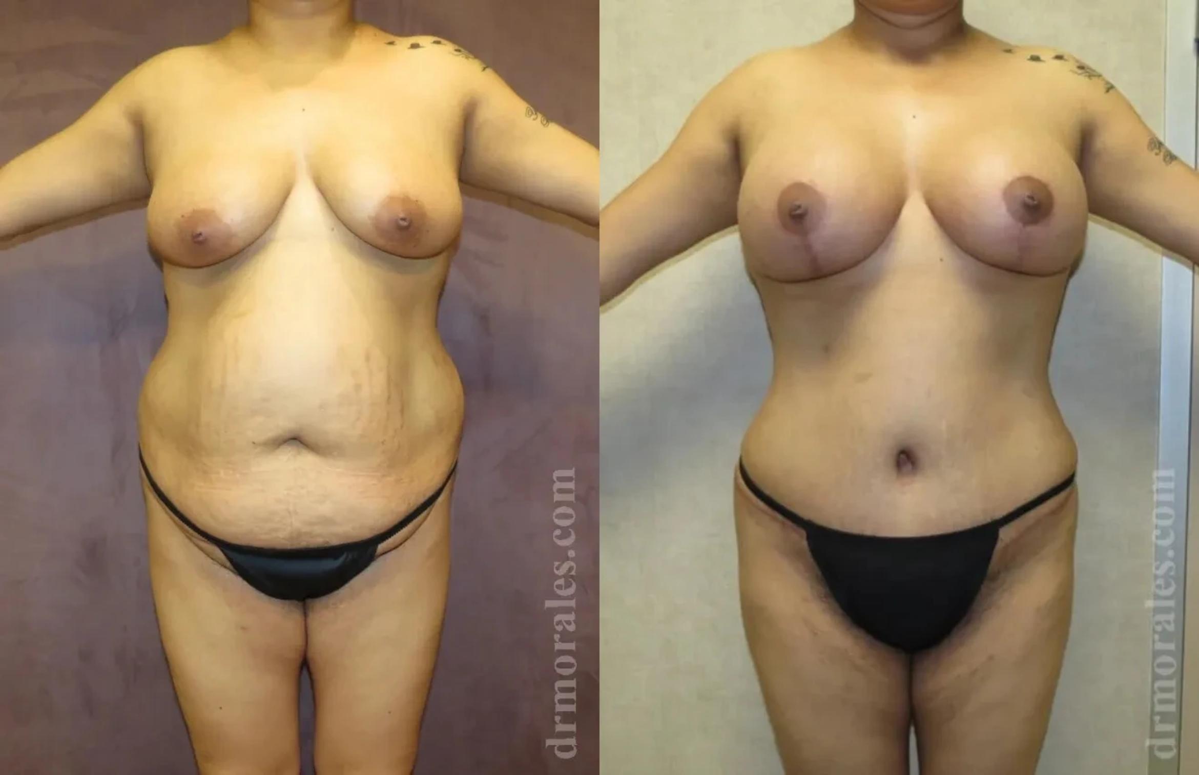 Before & After Mommy Makeover Case 250 View 1 View in Houston, TX