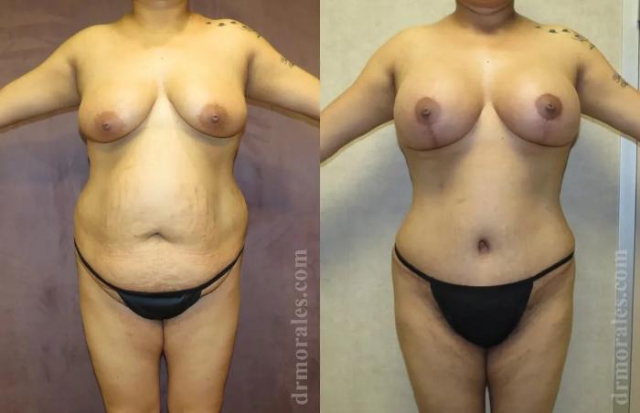 Before & After Mommy Makeover Case 250 View 1 View in Houston, TX