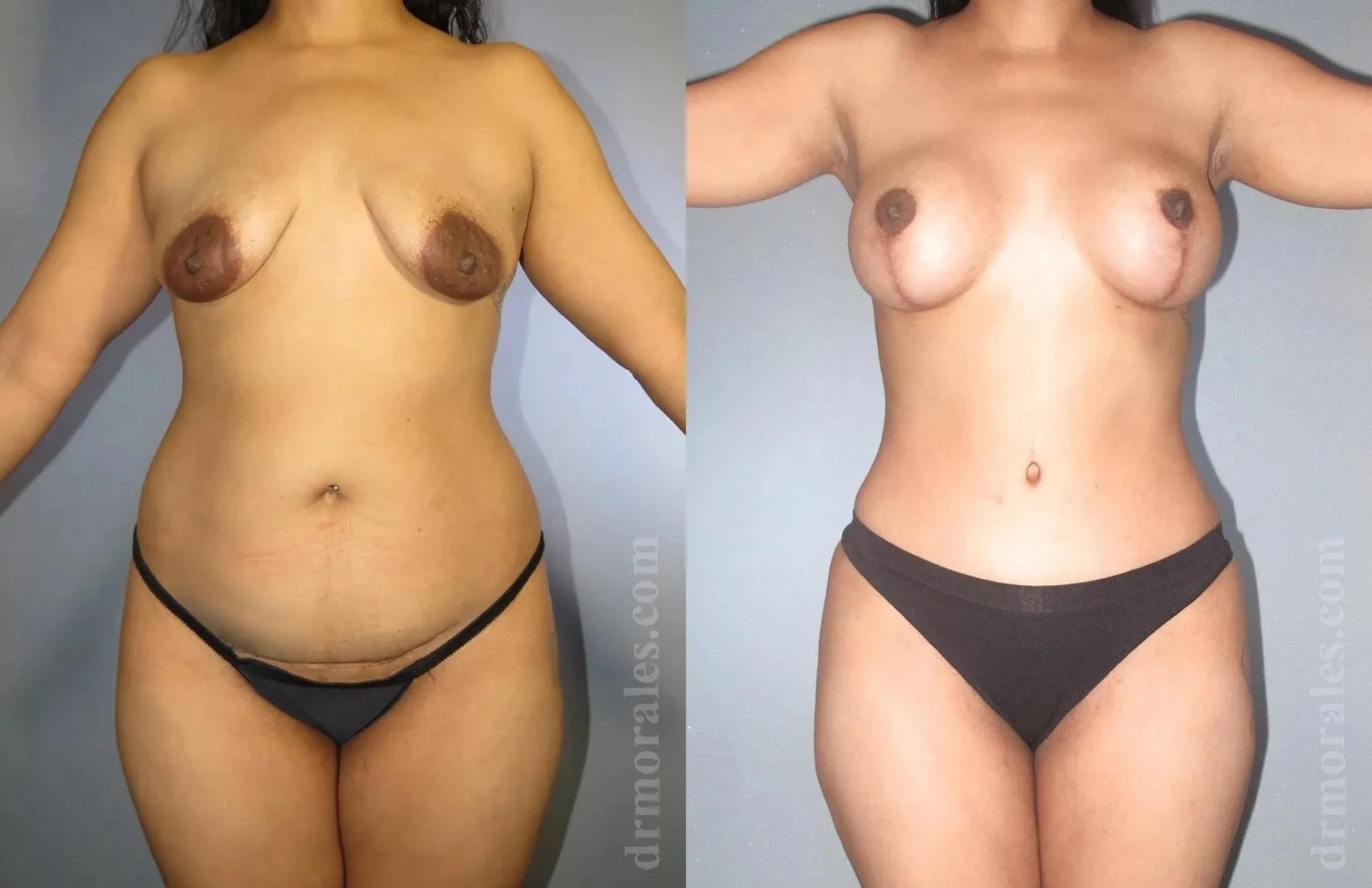 Before & After Mommy Makeover Case 251 View 1 View in Houston, TX