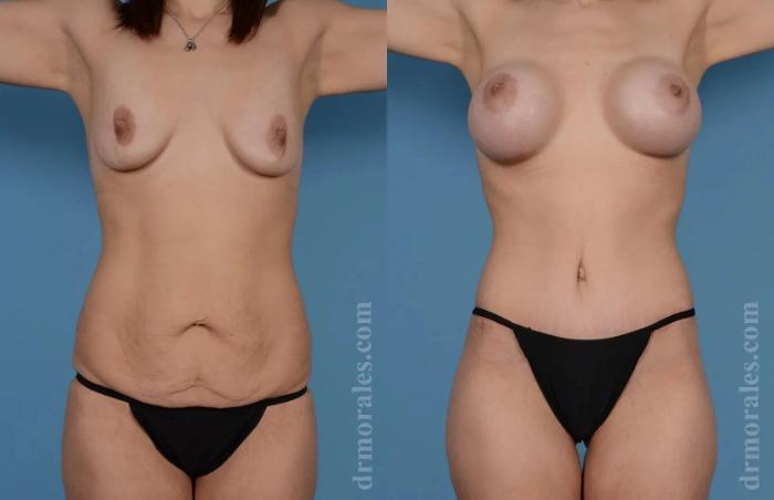 Before & After Mommy Makeover Case 252 View 1 View in Houston, TX