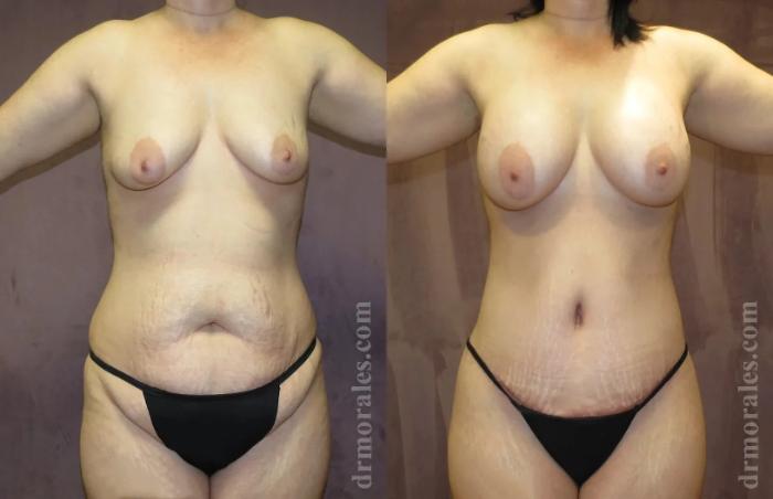 Before & After Mommy Makeover Case 253 View 1 View in Houston, TX