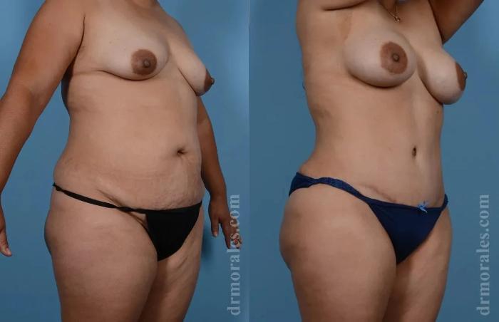 Before & After Mommy Makeover Case 254 View 1 View in Houston, TX