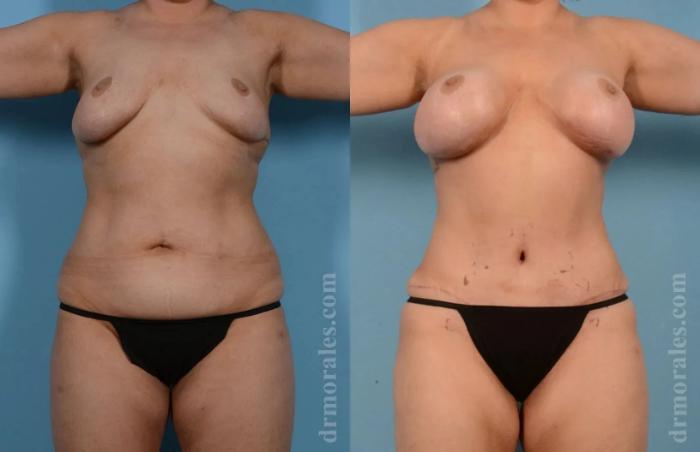 Before & After Mommy Makeover Case 255 View 1 View in Houston, TX