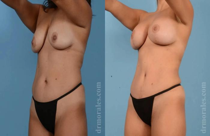 Before & After Mommy Makeover Case 257 View 1 View in Houston, TX