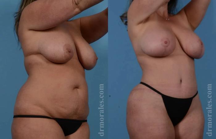 Before & After Mommy Makeover Case 258 View 1 View in Houston, TX