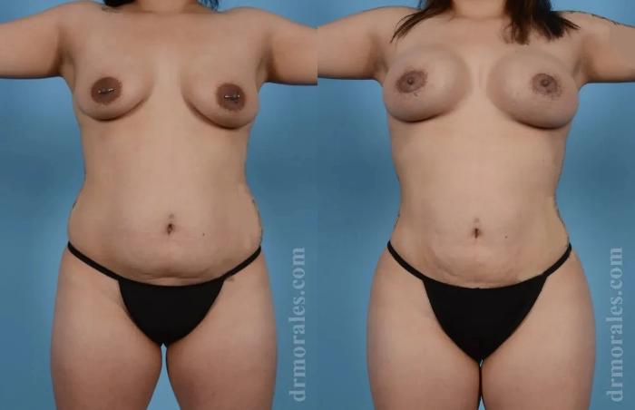 Before & After Mommy Makeover Case 259 View 1 View in Houston, TX